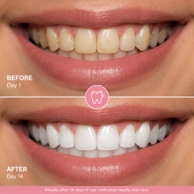Siare Smile Tooth Armour™
