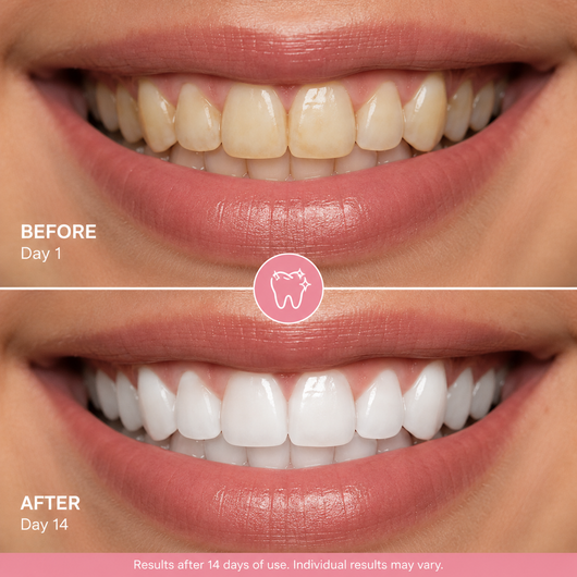 Siare Smile Tooth Armour™